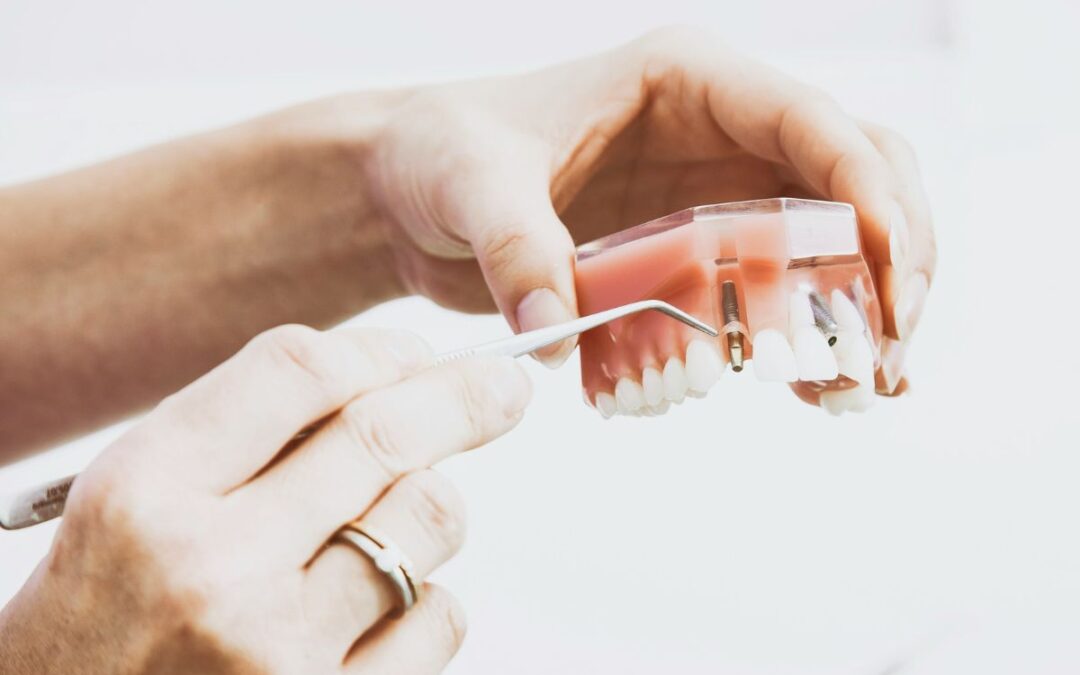 Implants dentals: tornar a somriure amb confiança